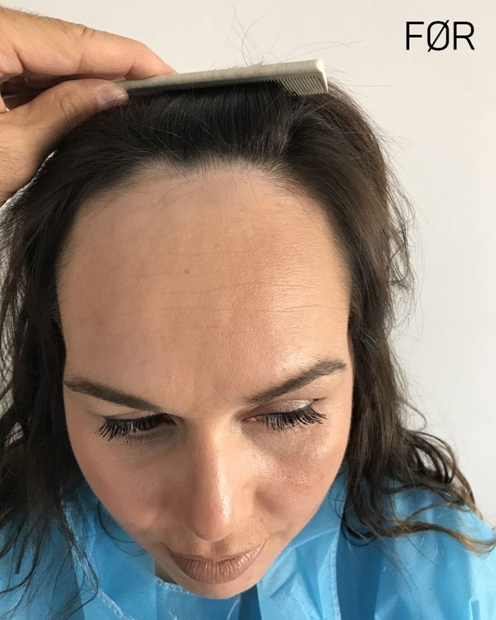 Kvinne før hårtransplantasjon.