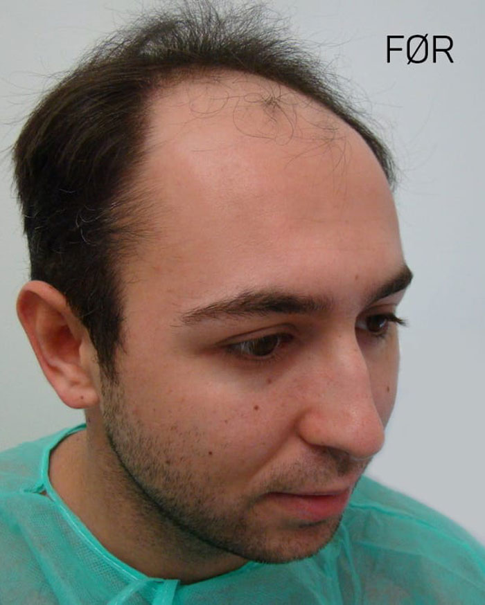 Mann før hårtransplantasjon.