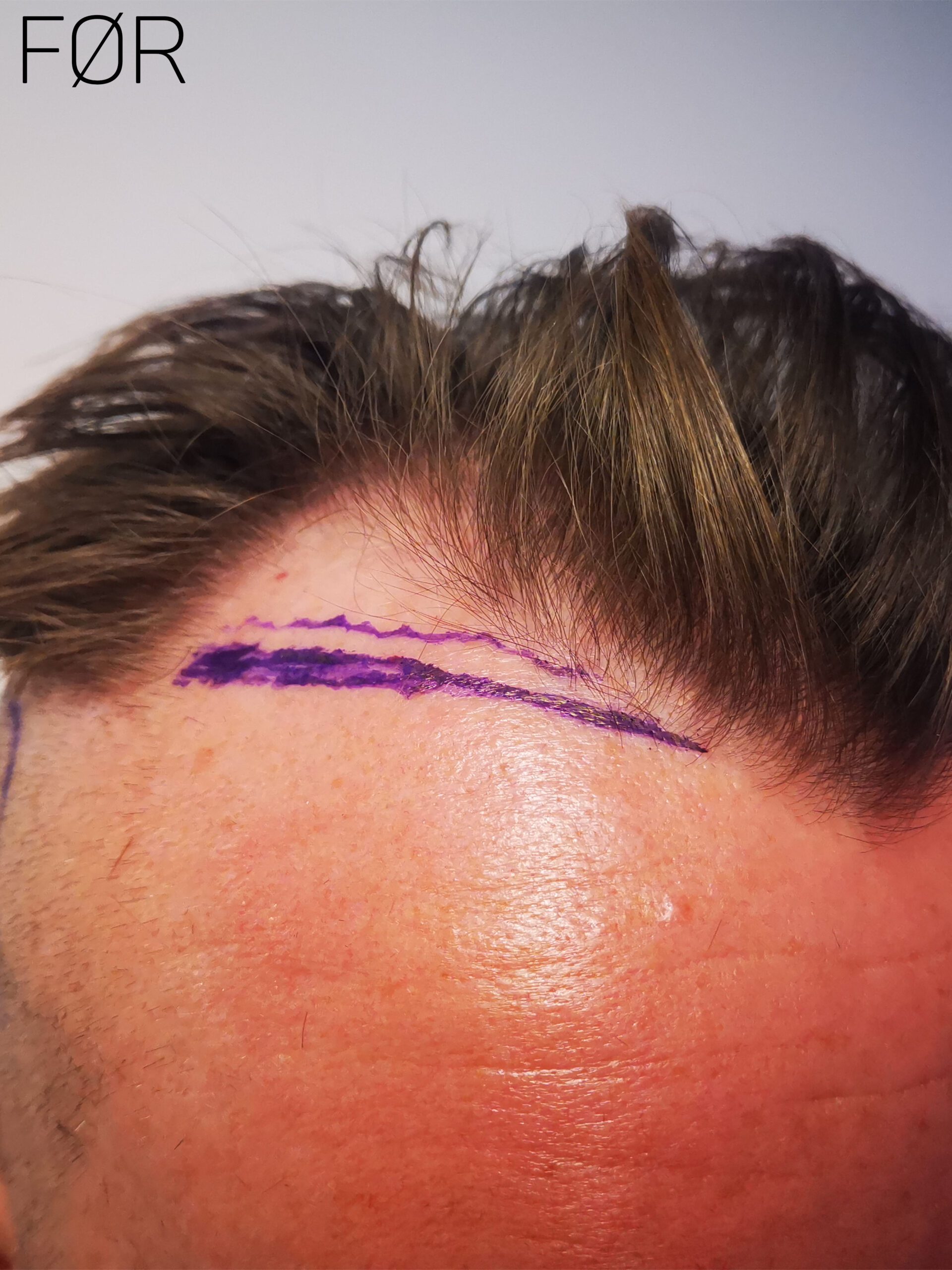 Mann før hårtransplantasjon. Hvit bakgrunn. Tegnet på hodet.