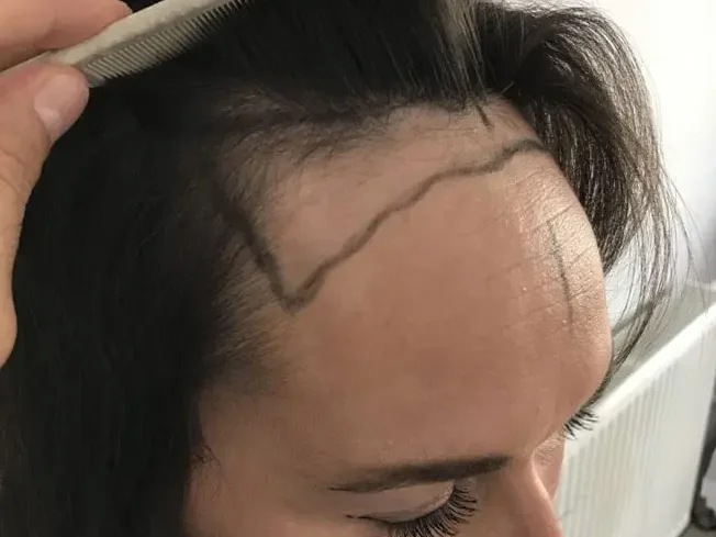 Kvinne før hårtransplantasjon som har fått markert nytt hårfeste med tusj.